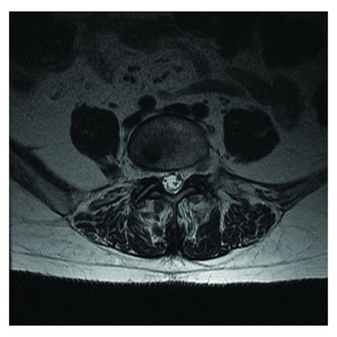Intraoperative Photograph Of Intraspinal Sacral Mass Resection