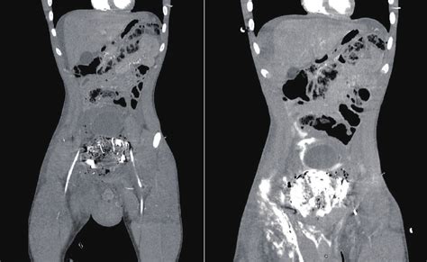 ct abdomen pelvis with cystogram showing contrast throughout pelvic download scientific diagram