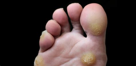 South Burnett Podiatry Is The Painful Lump On Your Foot A Wart Or A Corn