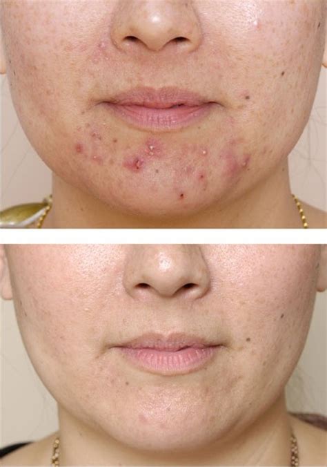 I tried every single face wash/cream with no luck. acne1 - Cystic Acne on Chin