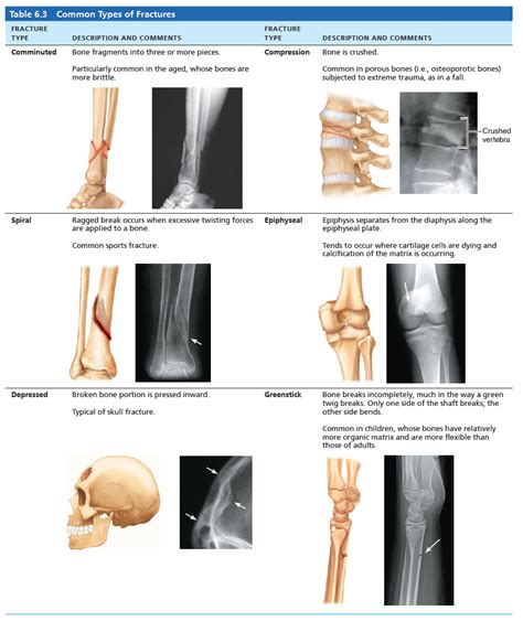 Describe The Different Types Of Fractures