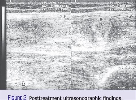 Figure 1 From Ultrasound Therapy In Iliopsoas Hematoma Semantic Scholar