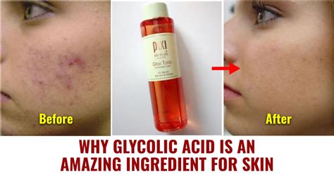 Why Glycolic Acid Is A Wonderful Ingredient For All Skin Types