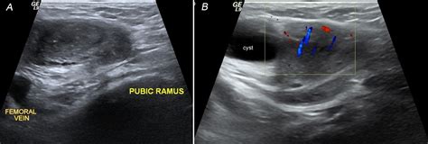 Case Report Incarcerated Femoral Hernia Containing Ovary Unusual