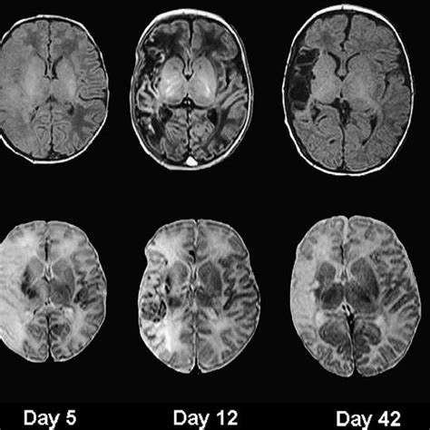 T1 And T2 Weighted Imaging Of Neonatal Stroke Serial T1 Upper Row