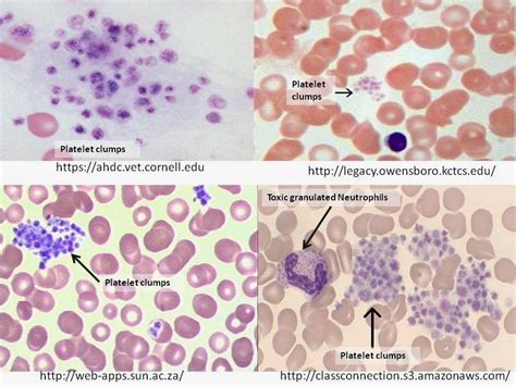 Haematology In A Nutshell Platelet Clumps