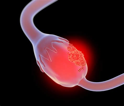The ovaries produce eggs and the female hormones estrogen and progesterone. Ovarian cancer: Scientists find a way to launch dual attack