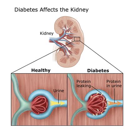 • determine likely cause of kidney disease where possible. Medicine Men!: Pathogenesis Mechanism of Proteinuria in ...