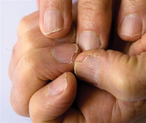 12 Disease Signs — Found On Our Fingernails A Listly List