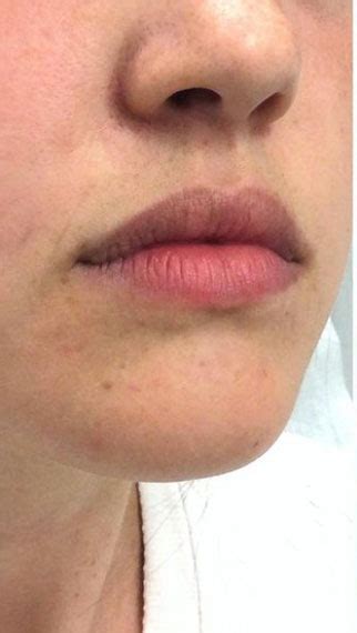 Patient 11329 Lip Enhancement Before And After Photos Burlington