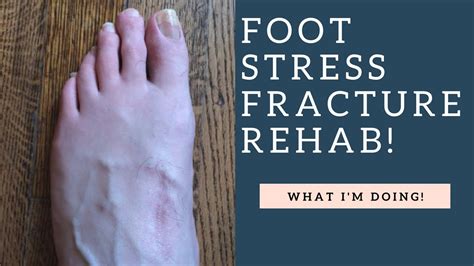 Exercise With Stress Fracture In Foot Exercisewalls
