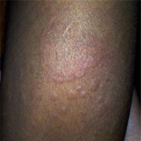 Erythematous Annular Papule Over Right Lower Limb With Central Clearing
