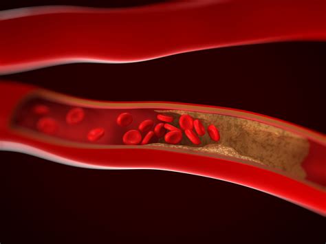 ¿qué Es La Arteriosclerosis