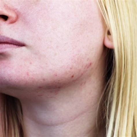 Acne Cyst Chin