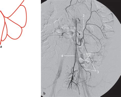 Inferior Mesenteric Artery Radiology Key