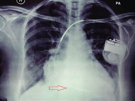 Preoperative Chest X Ray Showing The Automatic Implantable Cardioverter