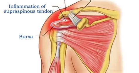 Supraspinatus Tendonitis The Causes Of Supraspinatus Tendinitis Can Be The Best Porn Website