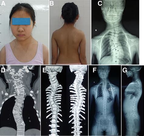 Case 2 A 12 Year Old Girl With C3 Hemivertebra A B Clinical