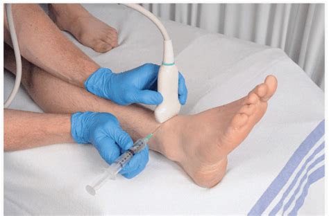 Ultrasound Guided Deep Peroneal Nerve Block At The Ankle Anesthesia Key