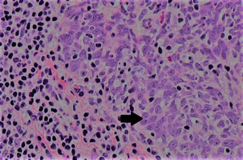 Cureus Case Of An Incidentally Found Squamous Cell