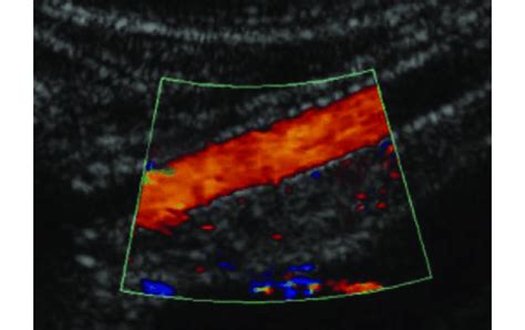 An Arterial Duplex Ultrasound Image Showed A Patent Axillary Artery