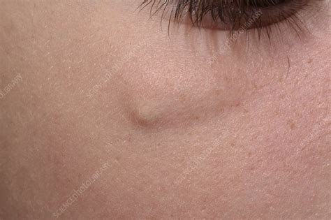 Epidermoid Cyst Stock Image C0472890 Science Photo Library