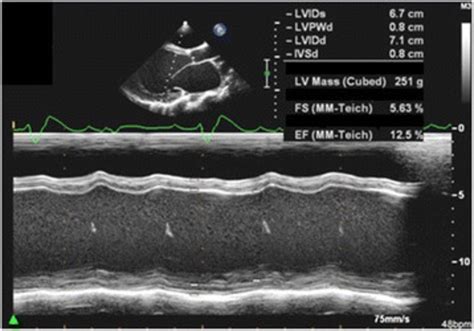 m mode echocardiographic recordings from the index patient showing download scientific diagram
