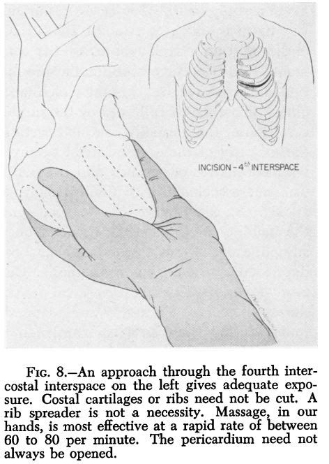 Cardiac Arrest Following Cardiac Surgery Deranged Physiology