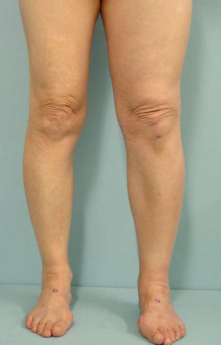 A Photograph Showing The Swelling Of The Left Leg Download