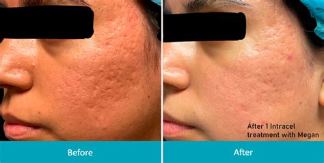 Intracel Acne Scar Treatment Montclair Nj Rf Microneedle System