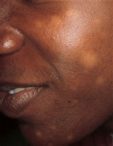 White Areas On The Face Of A Teenager The Clinical Advisor