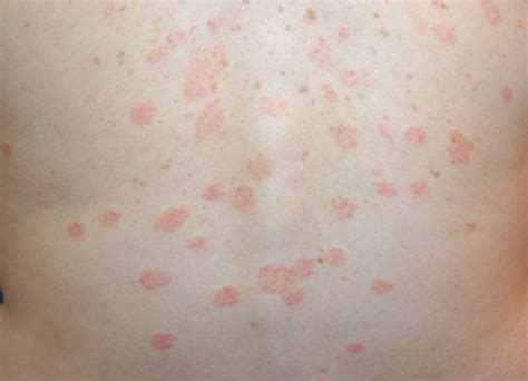 Medical Pictures Info Pityriasis Rosea