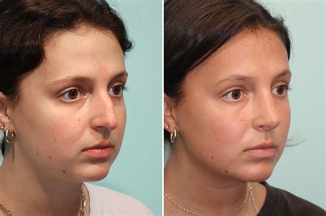 Rhinoplasty Photos Chevy Chase Md Patient 24476