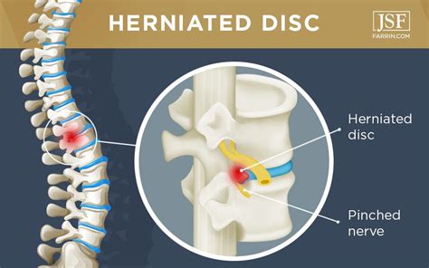 Herniated Discs And Back Injuries From Work James Scott Farrin