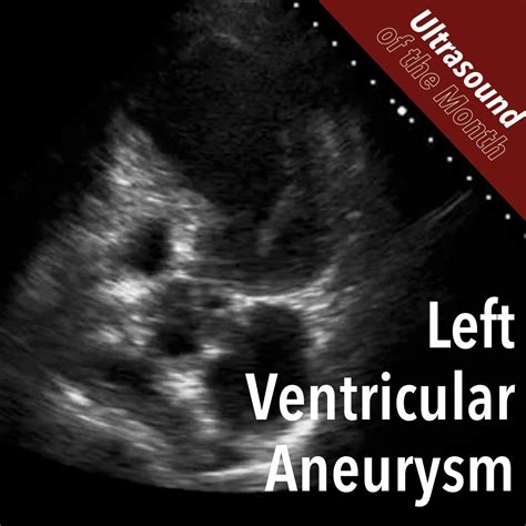 Ultrasound Of The Month Lv Aneurysm — Taming The Sru