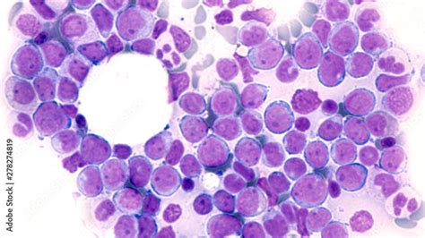 Fototapeta Leukemia Awareness Photomicrograph Of Bone Marrow Aspirate