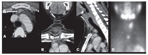 Imaging Localization And Surgical Approach In The Management Of Ectopic