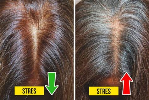 Saçlarımız Genç Yaşta Neden Beyazlar?