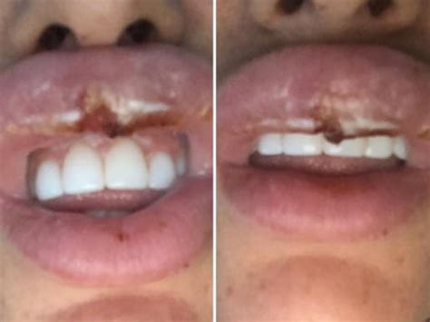 Botox Party Leaves Woman In Agony With Swollen Lips News Com Au