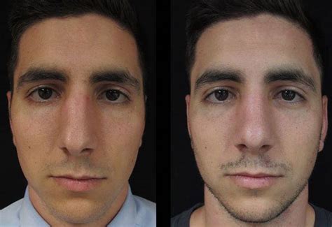 Crooked Nose Treatment Before And After Photos