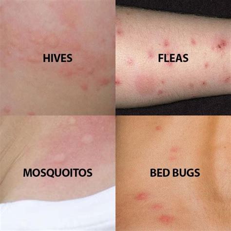 ~ Image Of What Different Bitesskin Conditions Look Like Bed Bug Bites Bug Bites Remedies