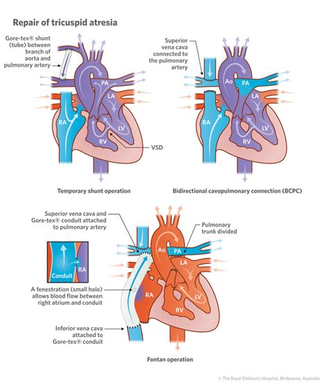 Cardiology Tricuspid Atresia