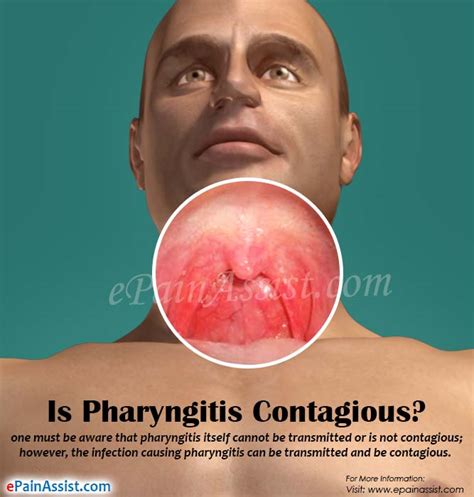 Is Pharyngitis Contagious And How Long Does It Last