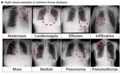 Pneumonia Chest X Ray Findings Hnhety