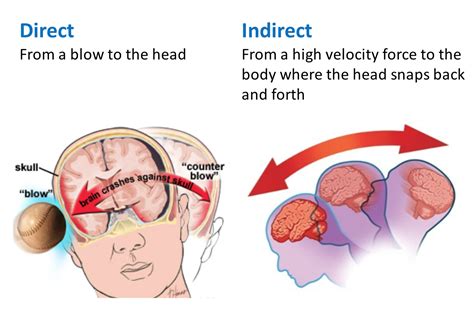 What Is A Concussion Sports Head Trauma