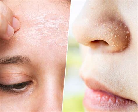 Flaky Skin On Nose And Forehead Home Treatment By Expert Flaky Skin