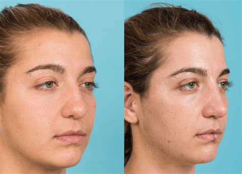 Rhinoplasty Coastal Facial Plastic Surgery And Aesthetics