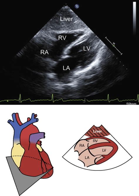 Transthoracic Echocardiography Standard Views Anesthesia Key