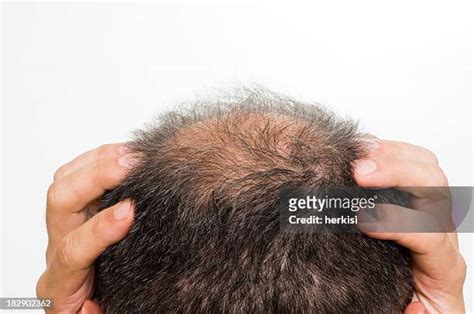 Bald Patch Photos And Premium High Res Pictures Getty Images