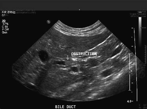 Ultrasound Image Of Obstructed Common Bile Duct At Initial Presentation